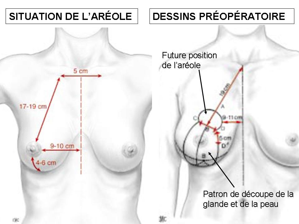 réduction mammaire tunisie