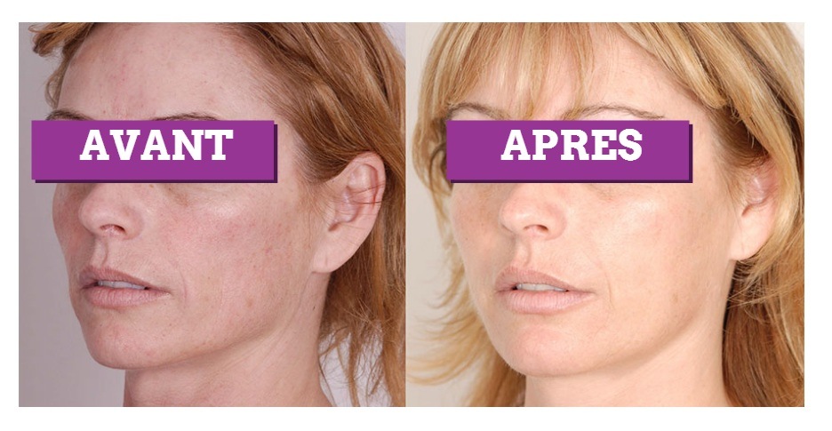 lipofilling visage tunisie